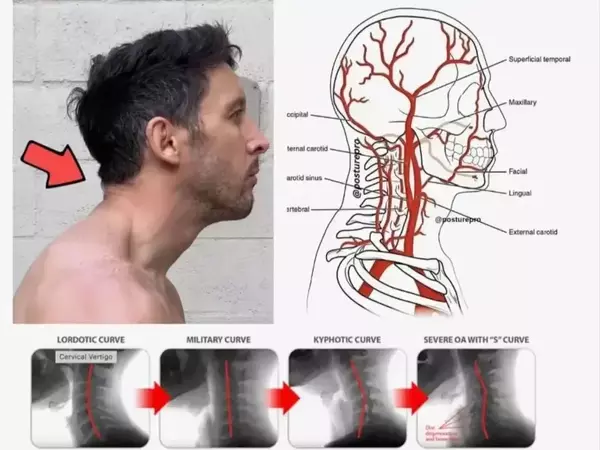  Позиция на главата напред и кръвообращение към мозъка: Скрит риск, който не бива да пренебрегвате